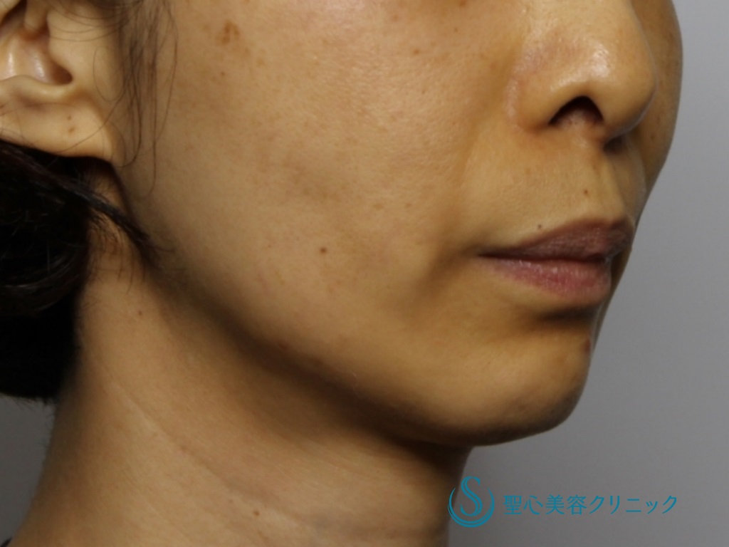 【40代女性・あご下のたるみと頬の凹み改善】フェイスリフト（リガメント処置併用）（3か月後） Before 