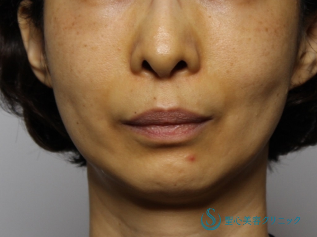 【40代女性・あご下のたるみと頬の凹み改善】フェイスリフト（リガメント処置併用）（3か月後） Before 