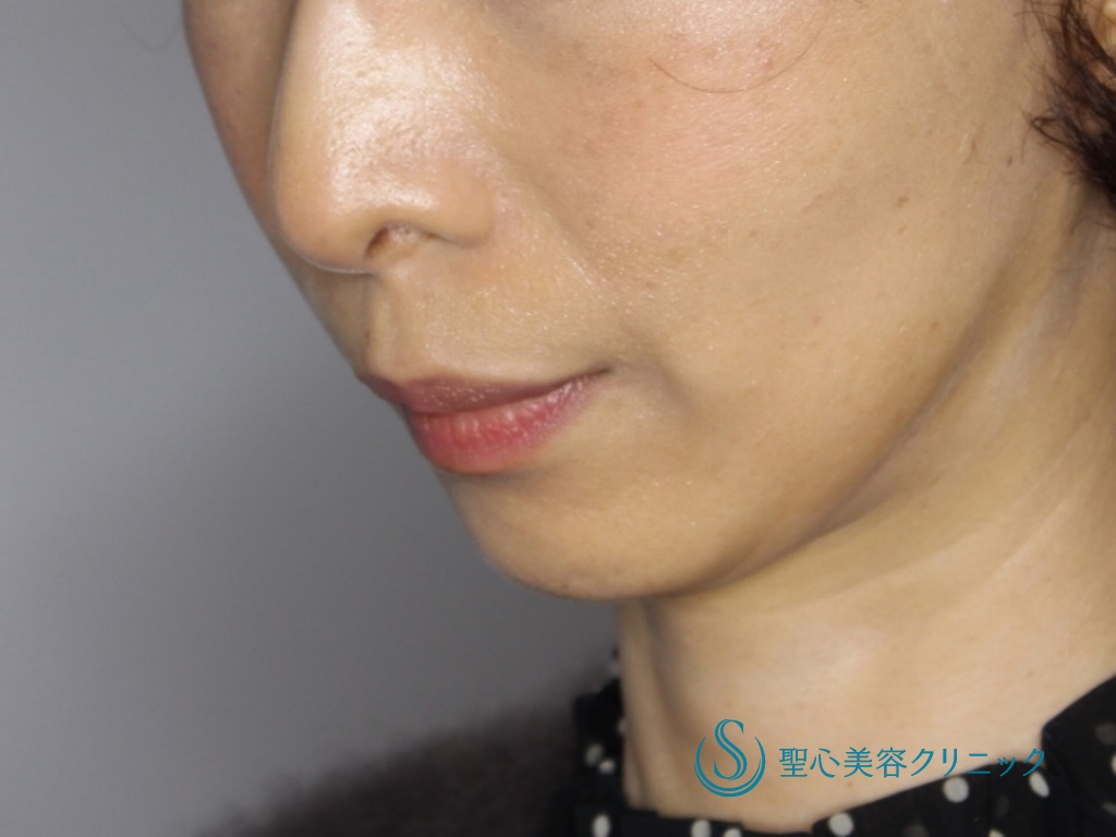 【40代女性・あご下のたるみと頬の凹み改善】フェイスリフト（リガメント処置併用）（3か月後） After 