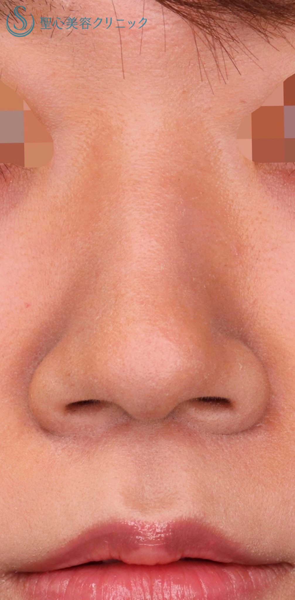 【20代女性・小鼻のコンプレックスを解消したい！！】小鼻縮小術（術後2ヶ月） Before 
