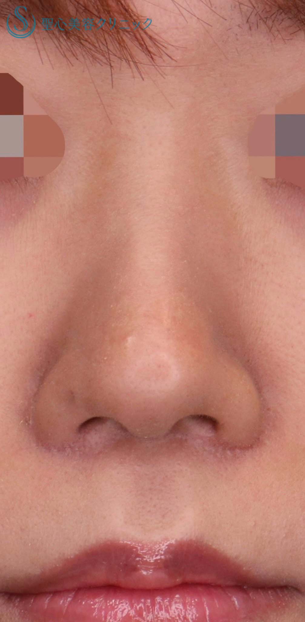 【20代女性・小鼻のコンプレックスを解消したい！！】小鼻縮小術（術後2ヶ月） After 