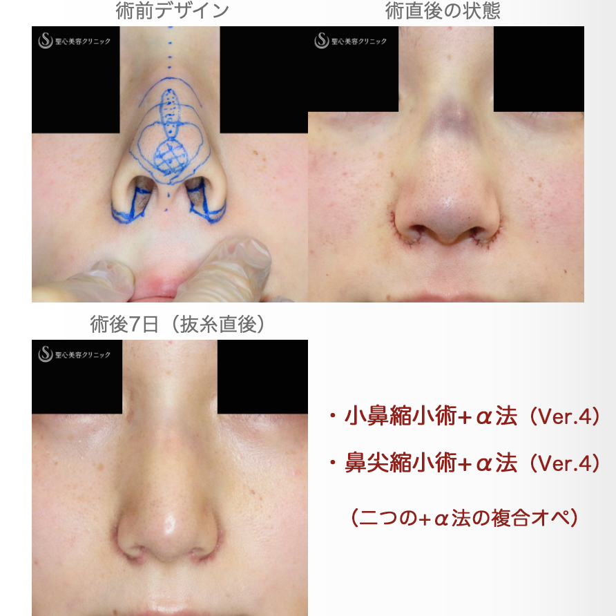 【20代女性・存在感のない「忘れ鼻」へ】小鼻縮小術+α法 ＆ 鼻尖縮小術+α法（4年9ヶ月後） Before 