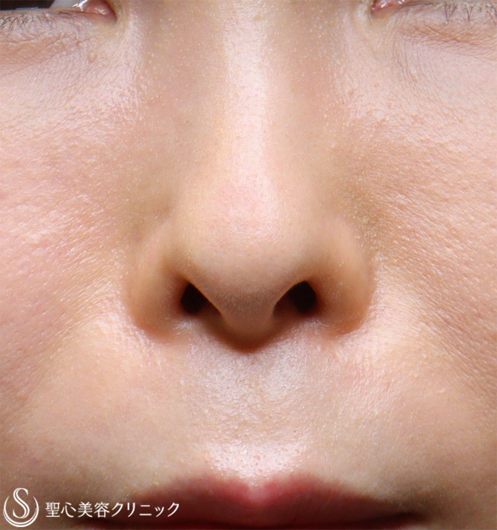 【40代女性・鼻の穴が見えるのが気になる】鼻孔縁下降術（1週間後） Before 