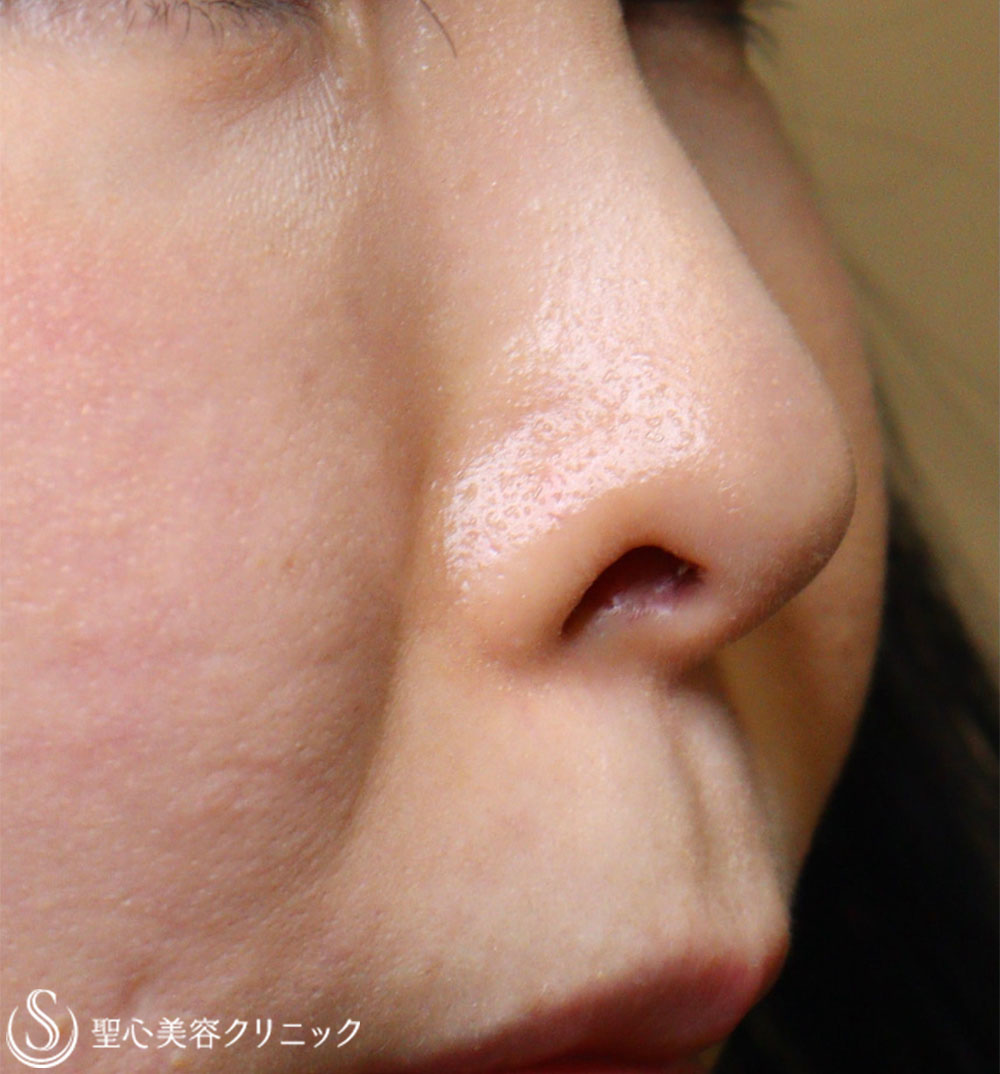 【40代女性・鼻の穴が見えるのが気になる】鼻孔縁下降術（1週間後） Before 
