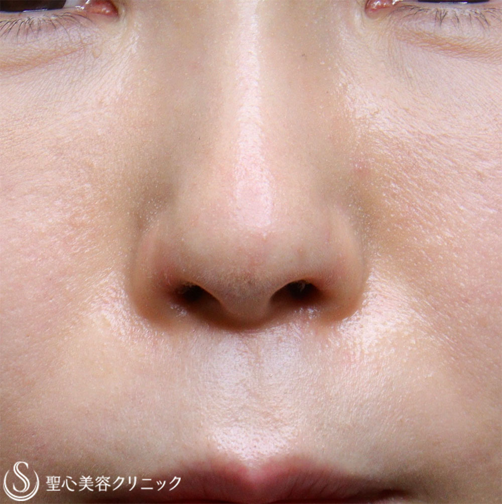 【40代女性・鼻の穴が見えるのが気になる】鼻孔縁下降術（1週間後） After 