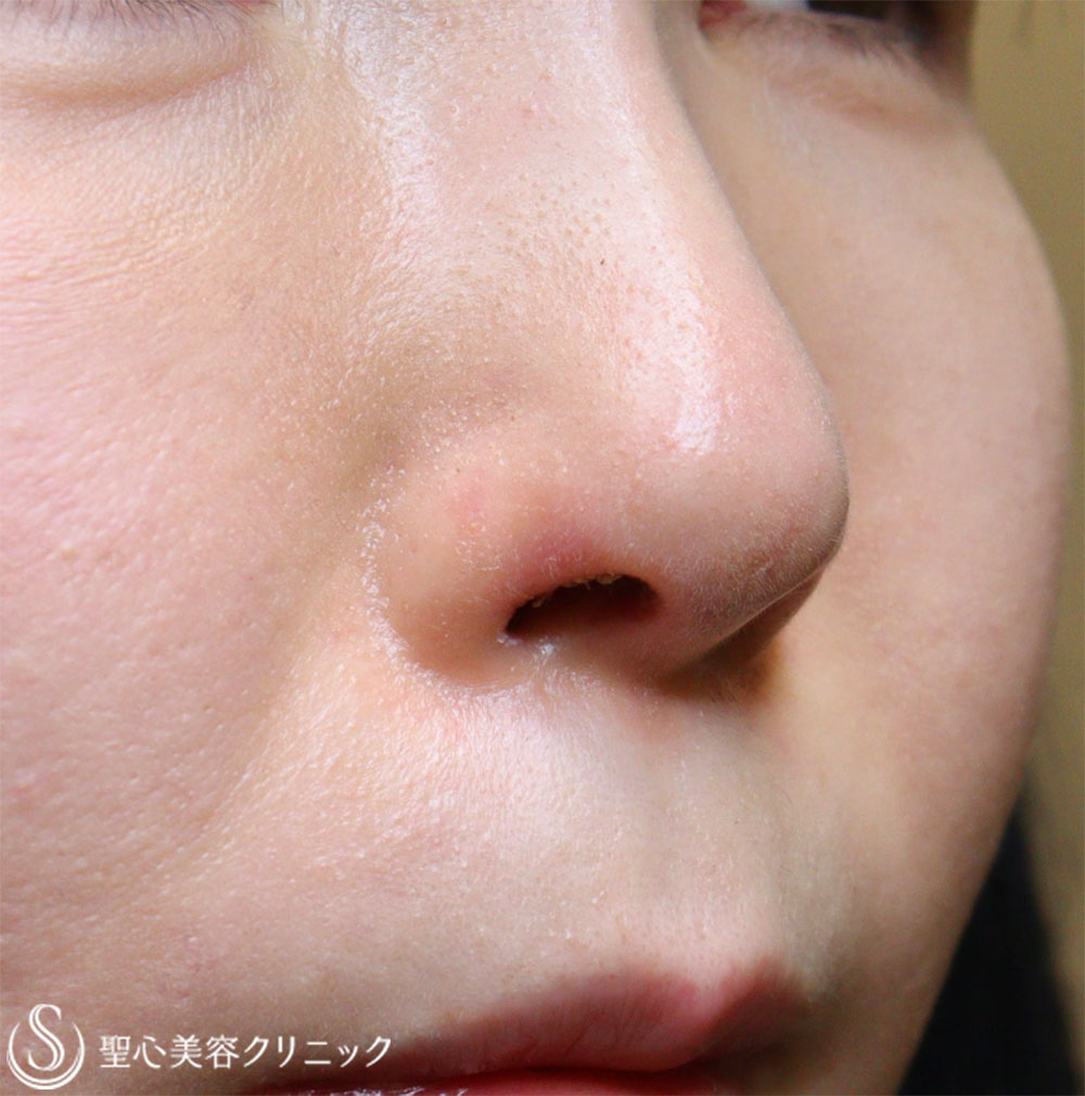 【40代女性・鼻の穴が見えるのが気になる】鼻孔縁下降術（1週間後） After 