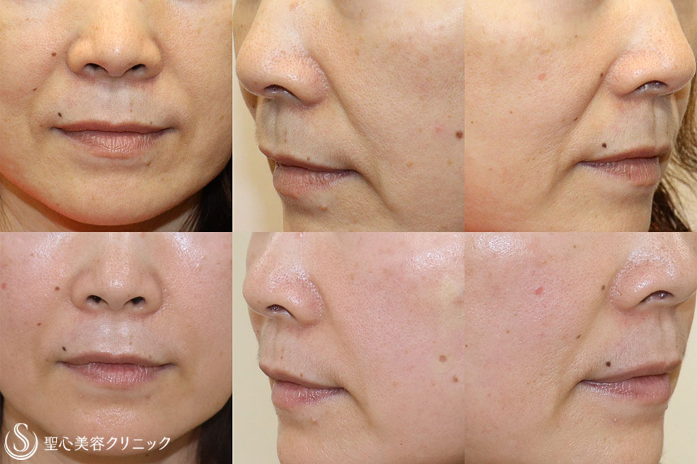 【50代女性・プレミアムPRP皮膚再生療法でほうれい線を消す】プレミアムPRP皮膚再生療法（3ヶ月後） After 