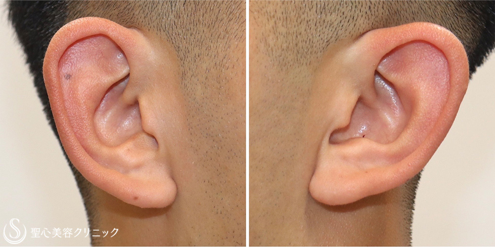 【20代男性・立ち耳手術で長年の悩みを解消】立ち耳修正（切開法）（1週間後） Before 