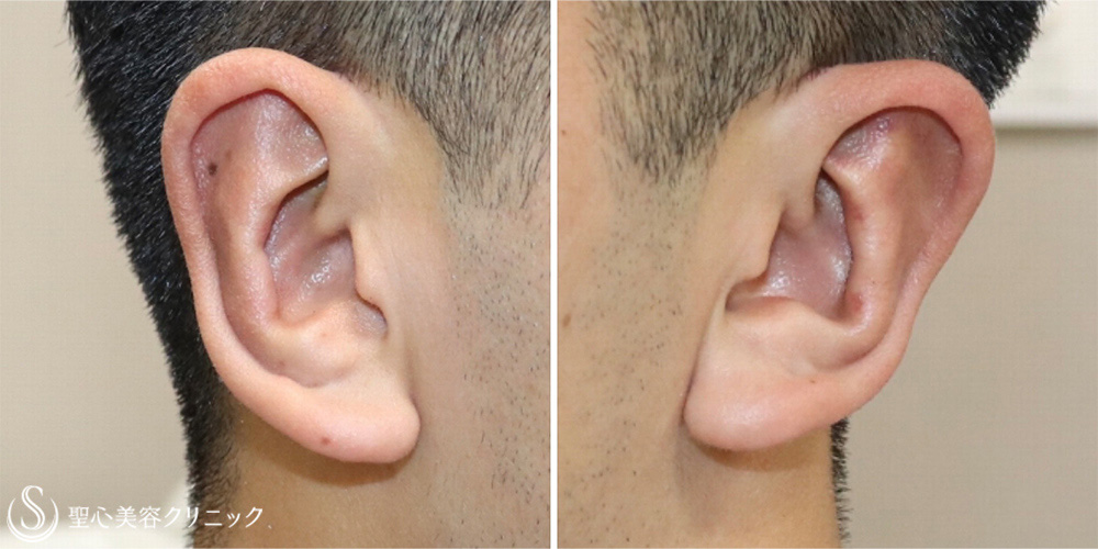【20代男性・立ち耳手術で長年の悩みを解消】立ち耳修正（切開法）（1週間後） After 