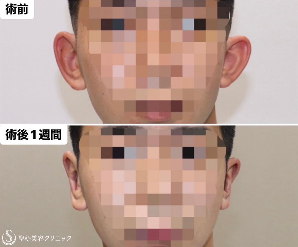 【20代男性・立ち耳手術で長年の悩みを解消】立ち耳修正（切開法）（1週間後） After 