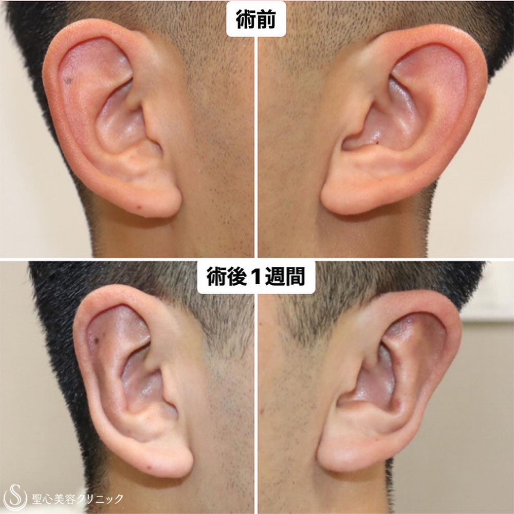 【20代男性・立ち耳手術で長年の悩みを解消】立ち耳修正（切開法）（1週間後） After 