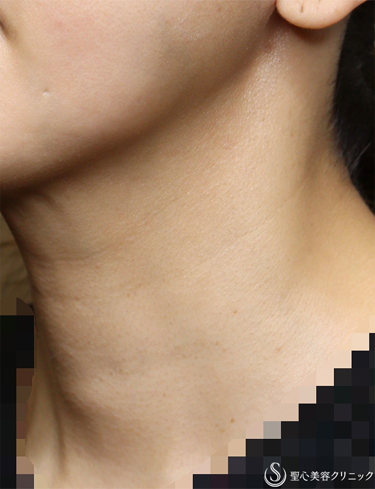 【40代女性・首の横ジワを治したい】プレミアムPRP皮膚再生療法（5ヶ月後） Before 