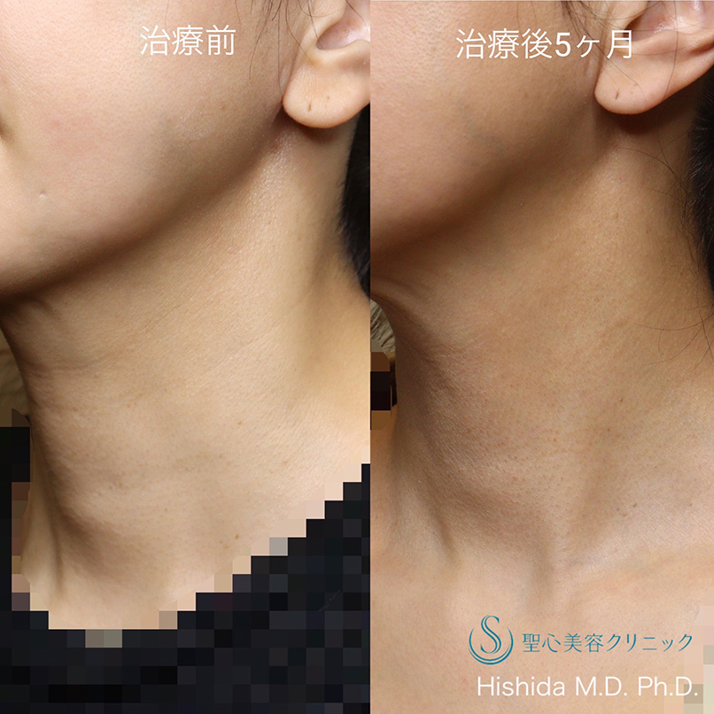 【40代女性・首の横ジワを治したい】プレミアムPRP皮膚再生療法（5ヶ月後） After 