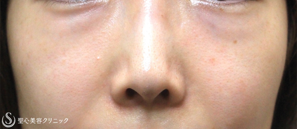 【30代女性・目の下の脂肪除去】目の下の脂肪取り（経結膜下脱脂法）（5年後） Before 