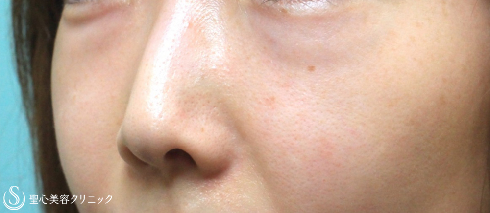【30代女性・目の下の脂肪除去】目の下の脂肪取り（経結膜下脱脂法）（5年後） Before 
