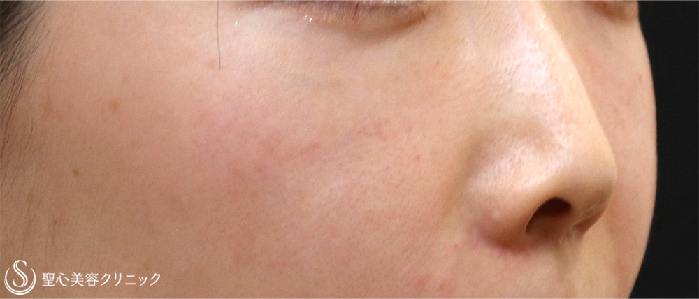 【30代女性・目の下の脂肪除去】目の下の脂肪取り（経結膜下脱脂法）（5年後） After 