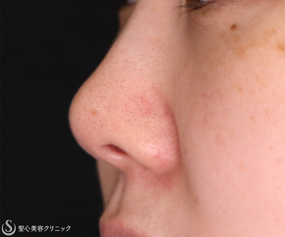 【30代女性・鼻先の耳介軟骨移植】鼻尖形成（耳介軟骨移植）（1週間後） Before 