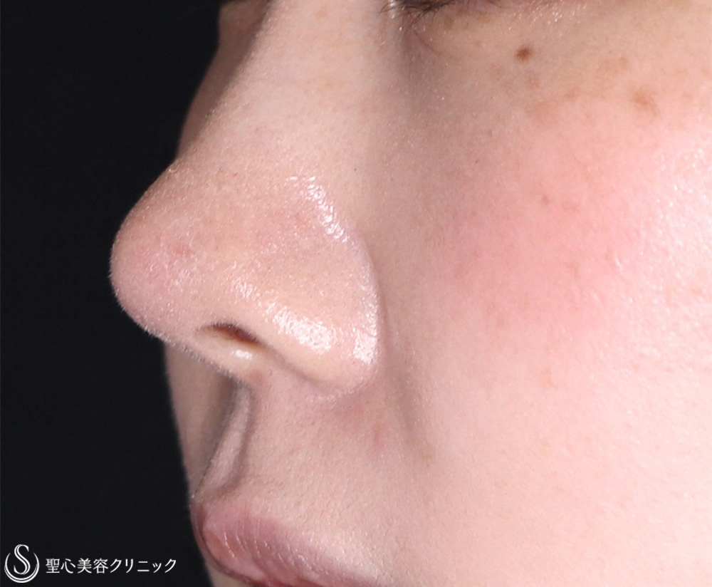 【30代女性・鼻先の耳介軟骨移植】鼻尖形成（耳介軟骨移植）（1週間後） After 