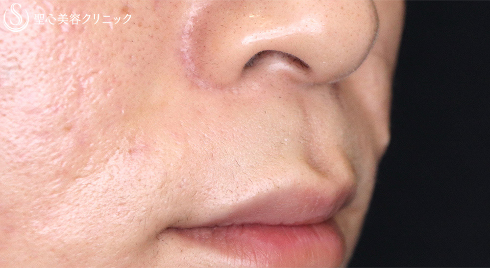 【20代男性・鼻の下を短く】鼻下短縮術（リップリフト）（1ヶ月後） Before 
