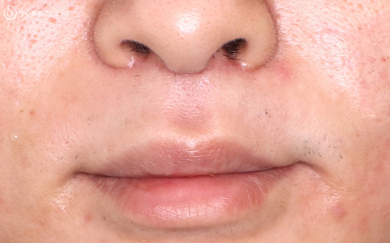 【20代男性・鼻の下を短く】鼻下短縮術（リップリフト）（1ヶ月後） After 