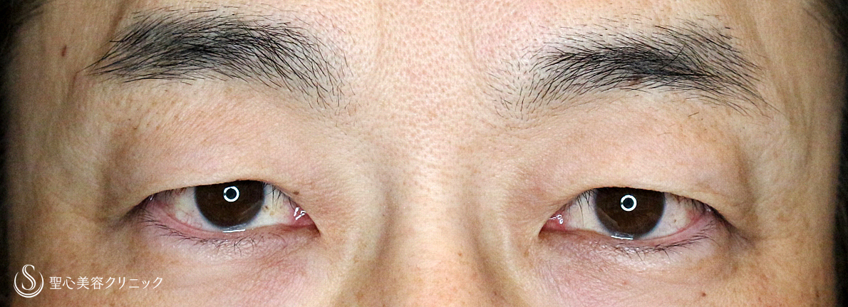 【40代男性・自然な目元の若返り】眉下リフト（1年後） Before 