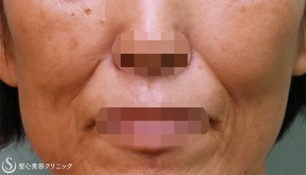 【50代女性・額、目の下、ほうれい線】プレミアムPRP皮膚再生療法（2回目注入後3か月、7か月、10か月） Before 