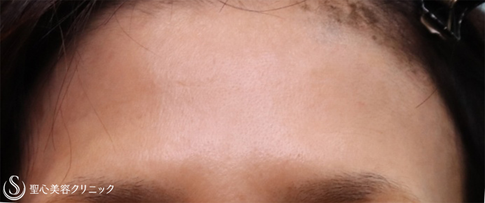 【50代女性・額、目の下、ほうれい線】プレミアムPRP皮膚再生療法（2回目注入後3か月、7か月、10か月） Before 