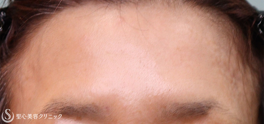 【50代女性・額、目の下、ほうれい線】プレミアムPRP皮膚再生療法（2回目注入後3か月、7か月、10か月） After 