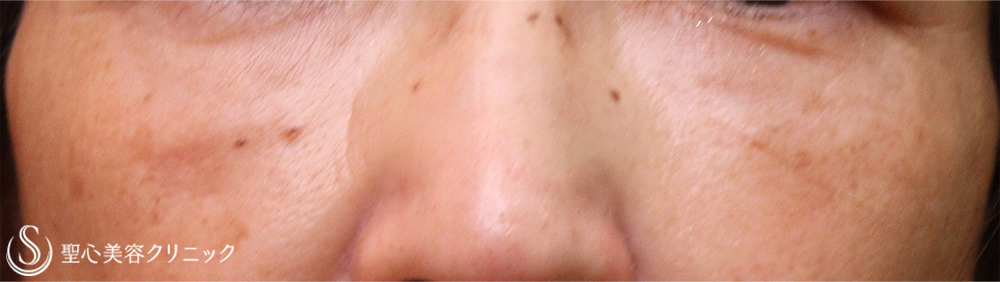 【50代女性・額、目の下、ほうれい線】プレミアムPRP皮膚再生療法（2回目注入後3か月、7か月、10か月） After 