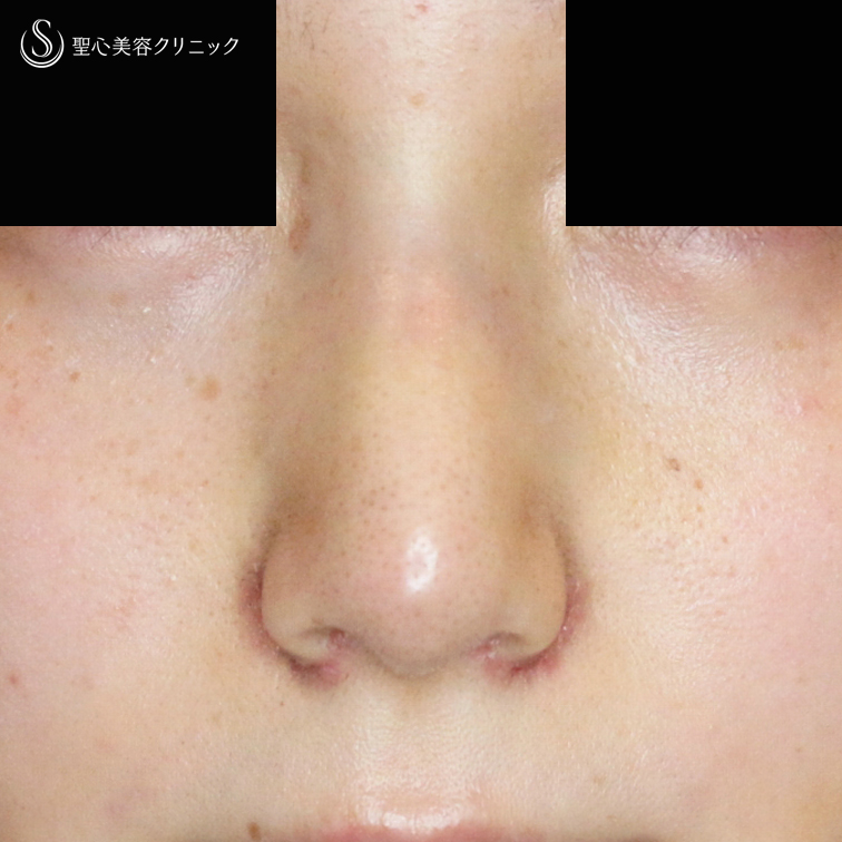 【20代女性・存在感のない「忘れ鼻」へ】小鼻縮小術+α法 ＆ 鼻尖縮小術+α法（4年9ヶ月後） After 