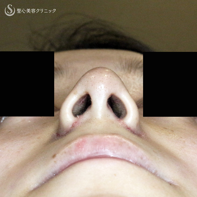 【20代女性・存在感のない「忘れ鼻」へ】小鼻縮小術+α法 ＆ 鼻尖縮小術+α法（4年9ヶ月後） After 