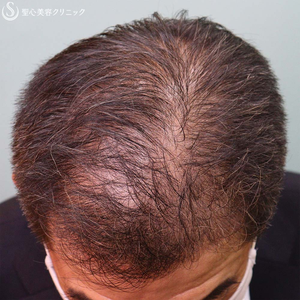 【60代男性・毛髪治療】リッシェゾーム毛髪再生治療（5回後） Before 