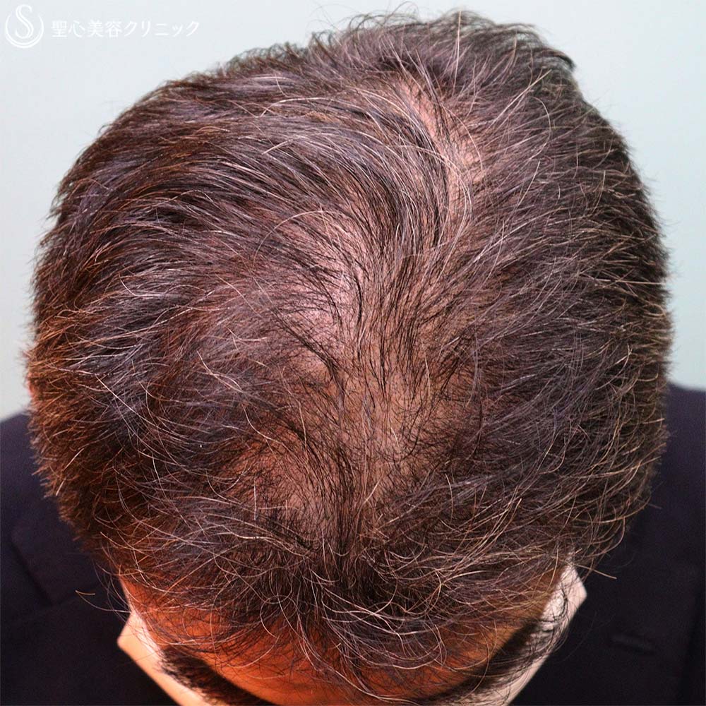 【60代男性・毛髪治療】リッシェゾーム毛髪再生治療（5回後） After 