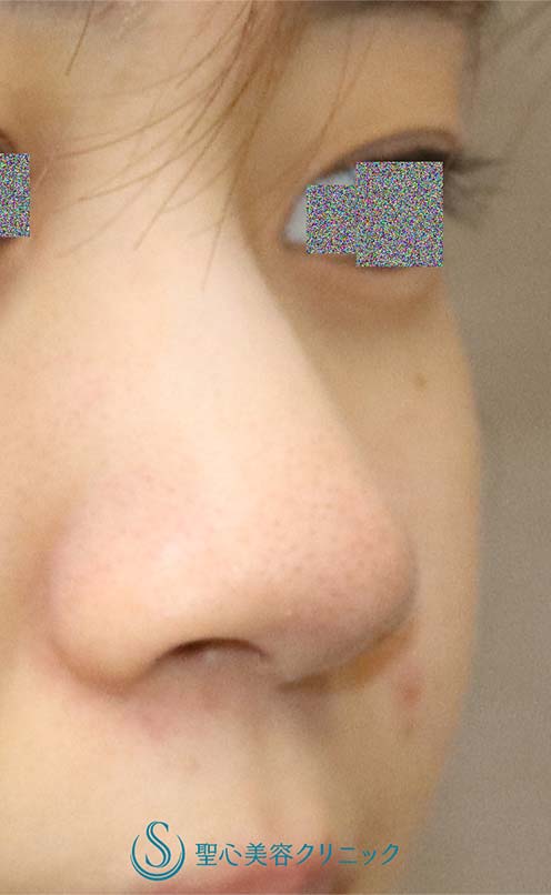 【20代女性・鼻先、小鼻の丸みを自然に改善】鼻尖縮小（オープン法）・鼻先耳介軟骨移植・小鼻縮小（1か月後） Before 