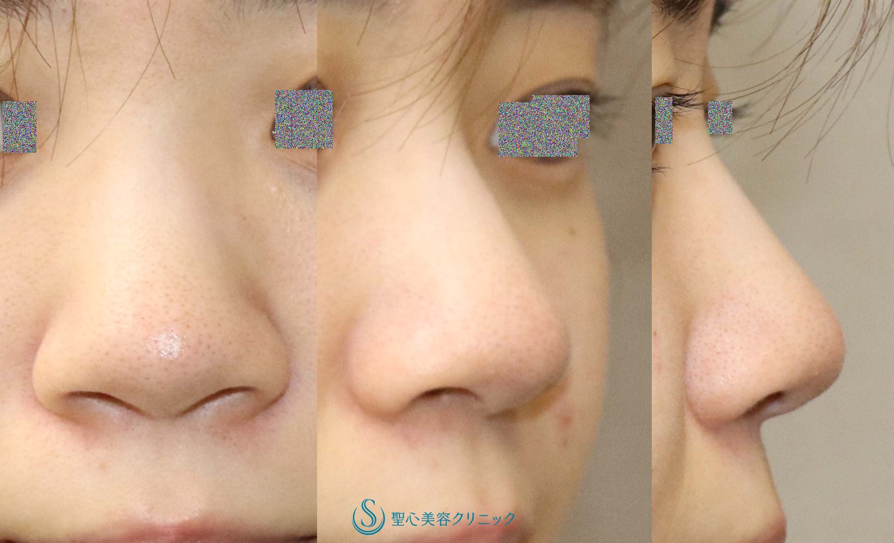 【20代女性・鼻先、小鼻の丸みを自然に改善】鼻尖縮小（オープン法）・鼻先耳介軟骨移植・小鼻縮小（1か月後） Before 