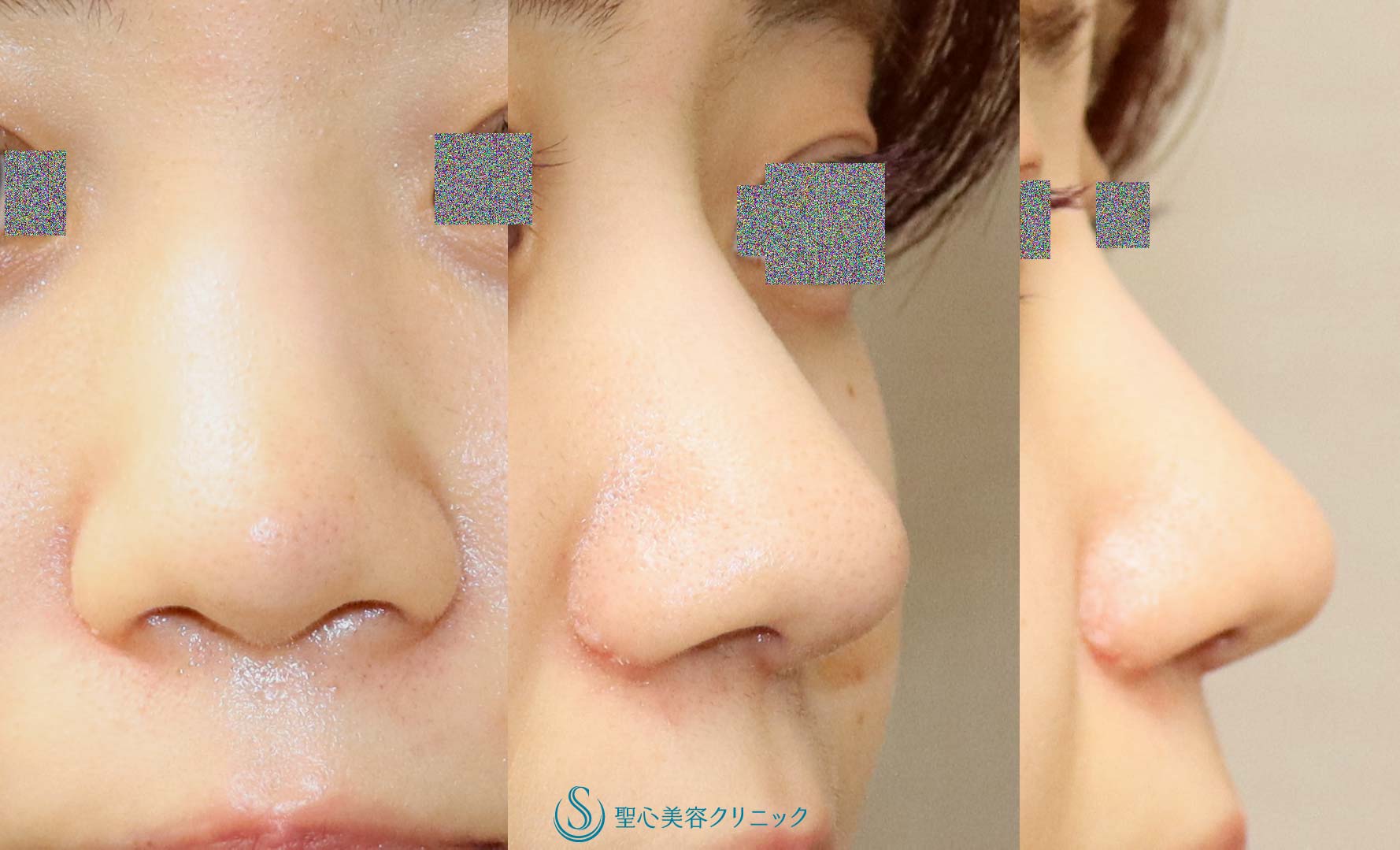 【20代女性・鼻先、小鼻の丸みを自然に改善】鼻尖縮小（オープン法）・鼻先耳介軟骨移植・小鼻縮小（1か月後） After 