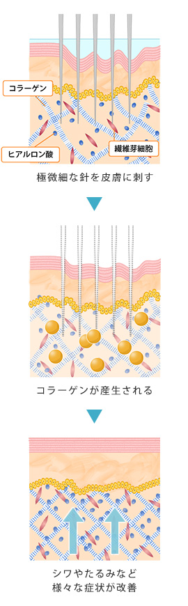 ダーマペン4の仕組み：ごく微細な針を皮膚に刺す→コラーゲンが産生される→シワやたるみなど様々な症状が改善