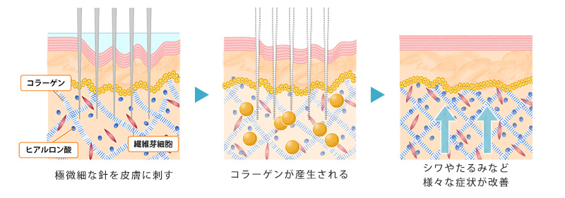 ダーマペン4の仕組み