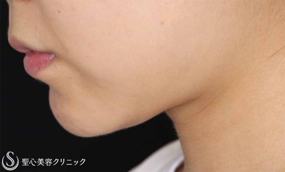 【30代女性・顎下の脂肪吸引】ベイザーリポ2.2脂肪吸引（1ヶ月後） After 