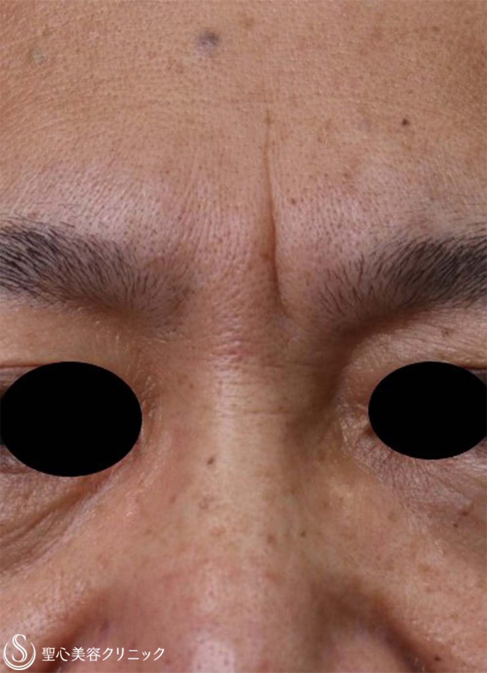 【50代男性・眉間のしわ】プレミアムPRP皮膚再生療法（6か月後） Before 
