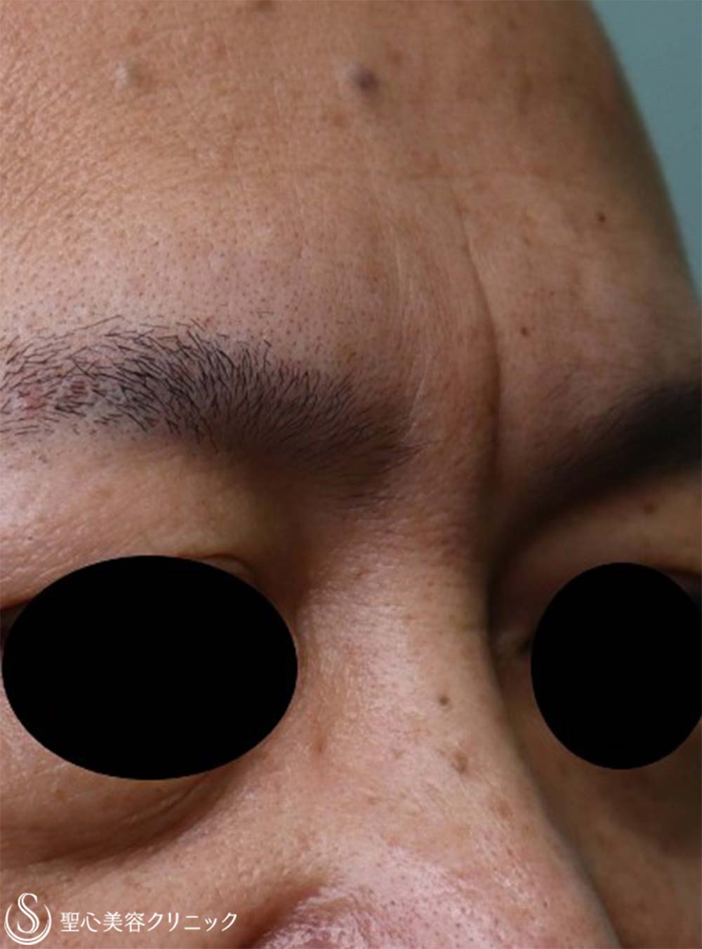 【50代男性・眉間のしわ】プレミアムPRP皮膚再生療法（6か月後） Before 