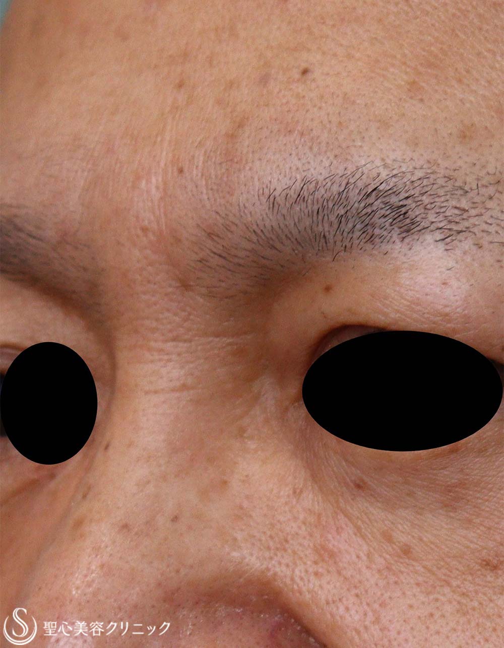 【50代男性・眉間のしわ】プレミアムPRP皮膚再生療法（6か月後） After 