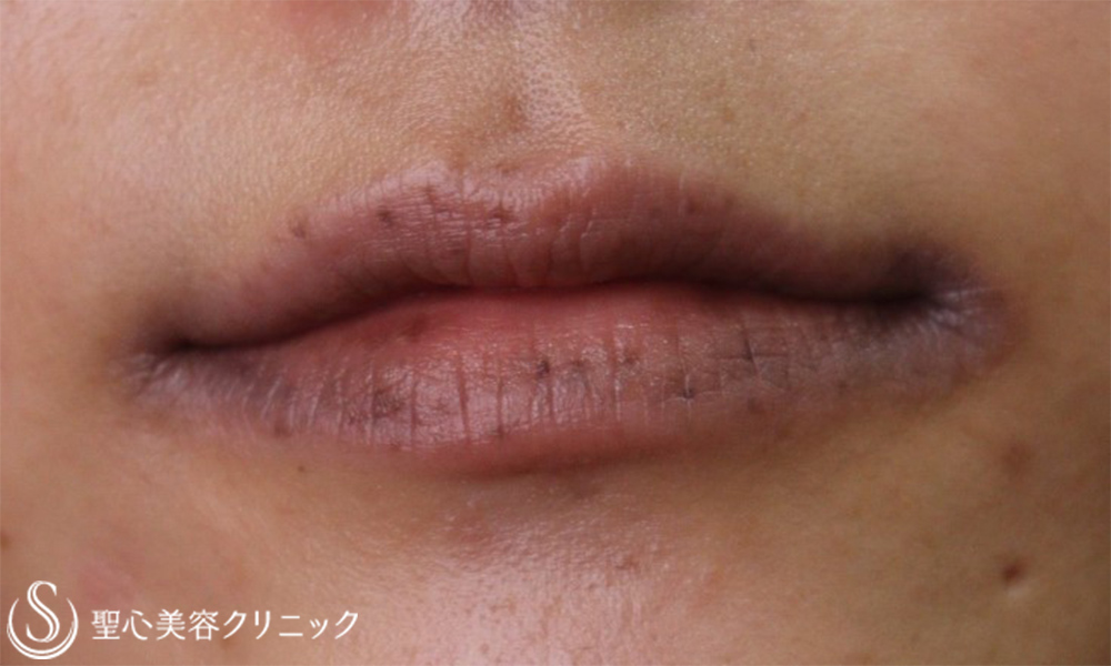 【30代女性・唇のしみ】PICOレーザー（6か月後） Before 
