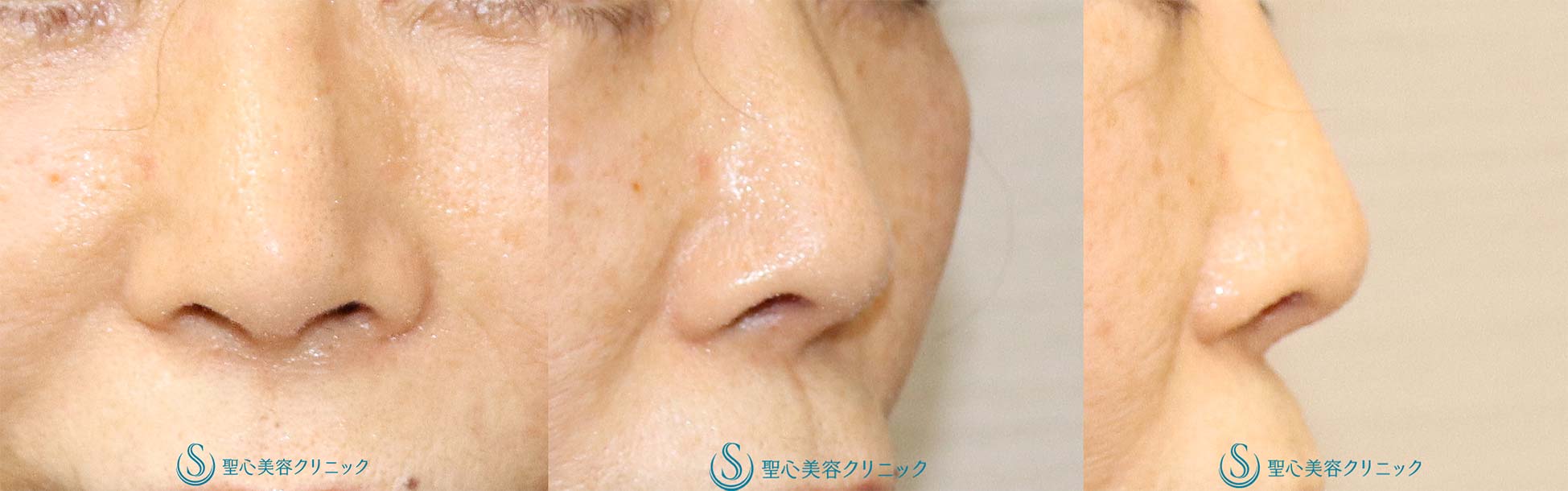 【70代女性・鼻先、小鼻の丸みを自然に改善して鼻先を細くしたい】鼻尖耳介軟骨移植＋小鼻縮小（術後1か月） Before 