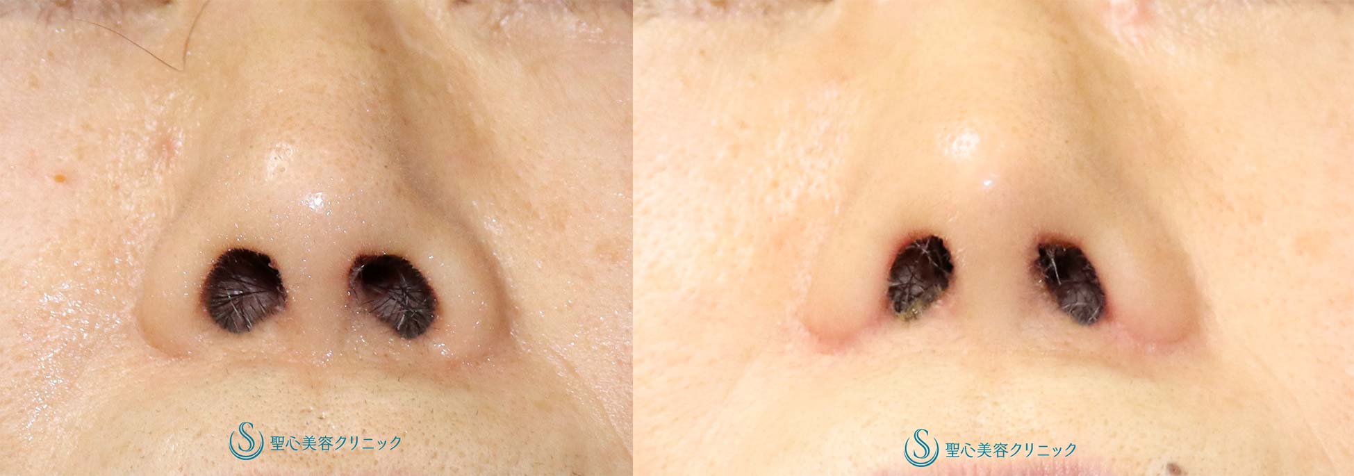 【70代女性・鼻先、小鼻の丸みを自然に改善して鼻先を細くしたい】鼻尖耳介軟骨移植＋小鼻縮小（術後1か月） After 