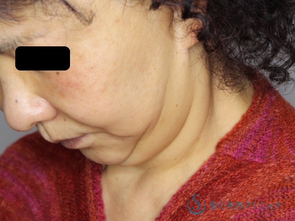 【50代女性・二重あごと首のたるみ改善】あご下～ネックリフト（あご下のベイザー脂肪吸引併用）（術後1か月） Before 