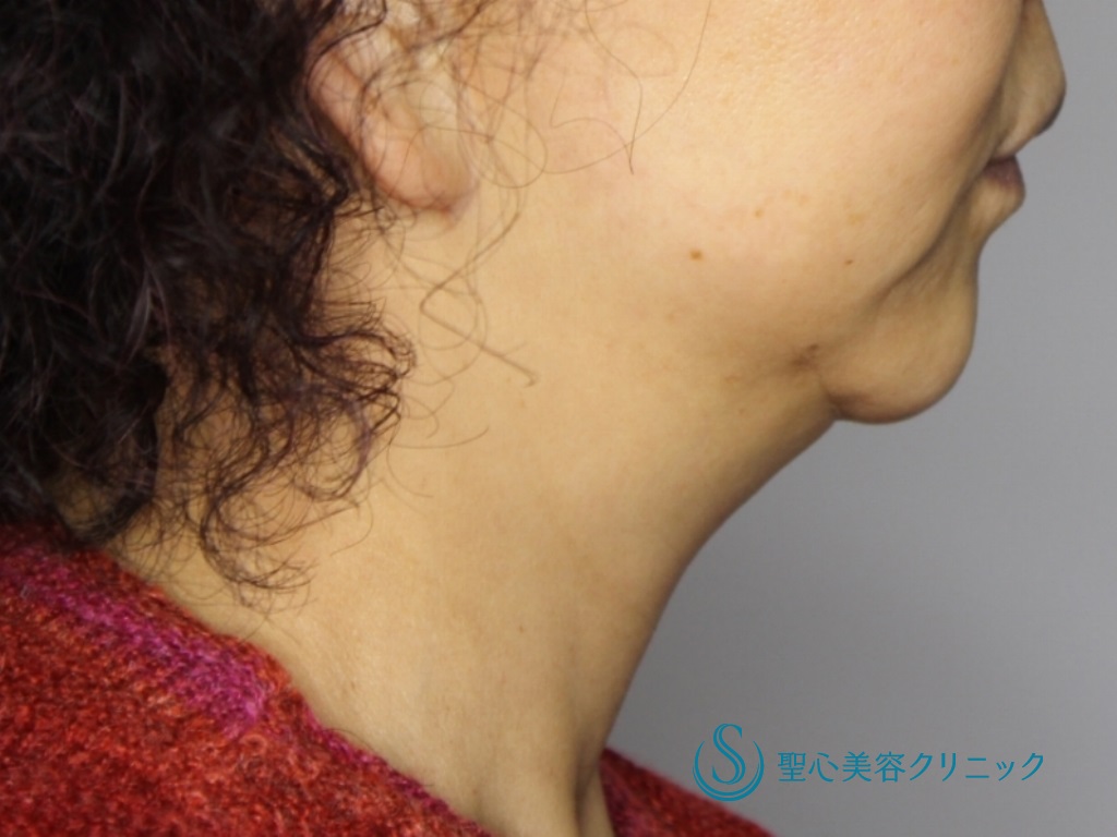 【50代女性・二重あごと首のたるみ改善】あご下～ネックリフト（あご下のベイザー脂肪吸引併用）（術後1か月） Before 