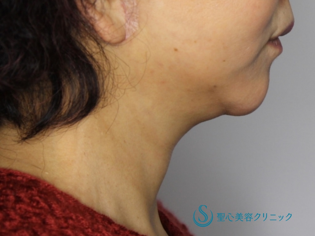 【50代女性・二重あごと首のたるみ改善】あご下～ネックリフト（あご下のベイザー脂肪吸引併用）（術後1か月） After 
