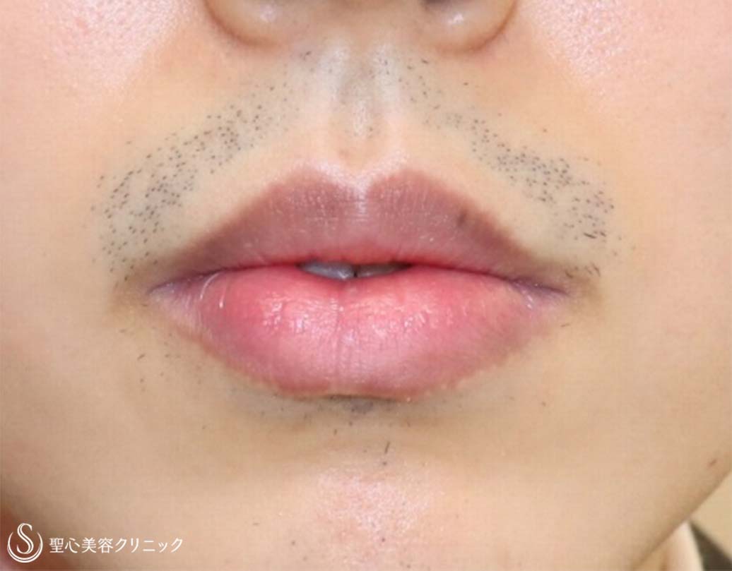 【20代男性・口角をあげて、いつでも微笑みを】プレミアム口角挙上術（術直後） Before 