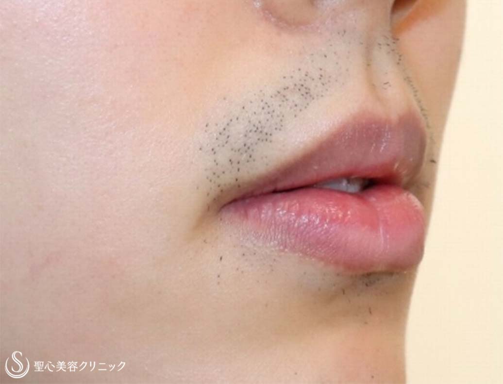 【20代男性・口角をあげて、いつでも微笑みを】プレミアム口角挙上術（術直後） Before 